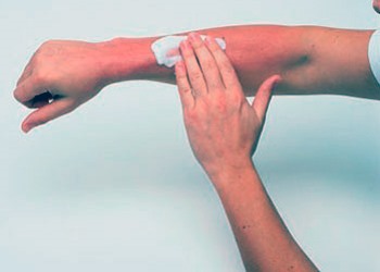 eczema